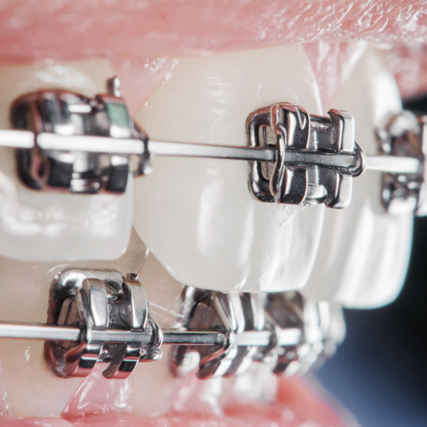 close-up-dental-braces-on-teeth-orthodontic-treat-2025-01-16-22-32-31-utc